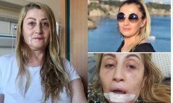 Dudak dolgusu yaptırdı, hayatı kabusa döndü!