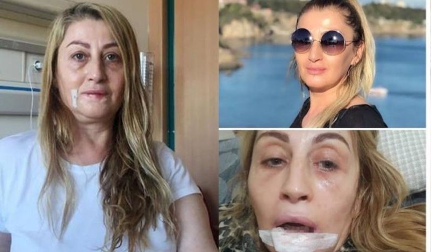 Dudak dolgusu yaptırdı, hayatı kabusa döndü!
